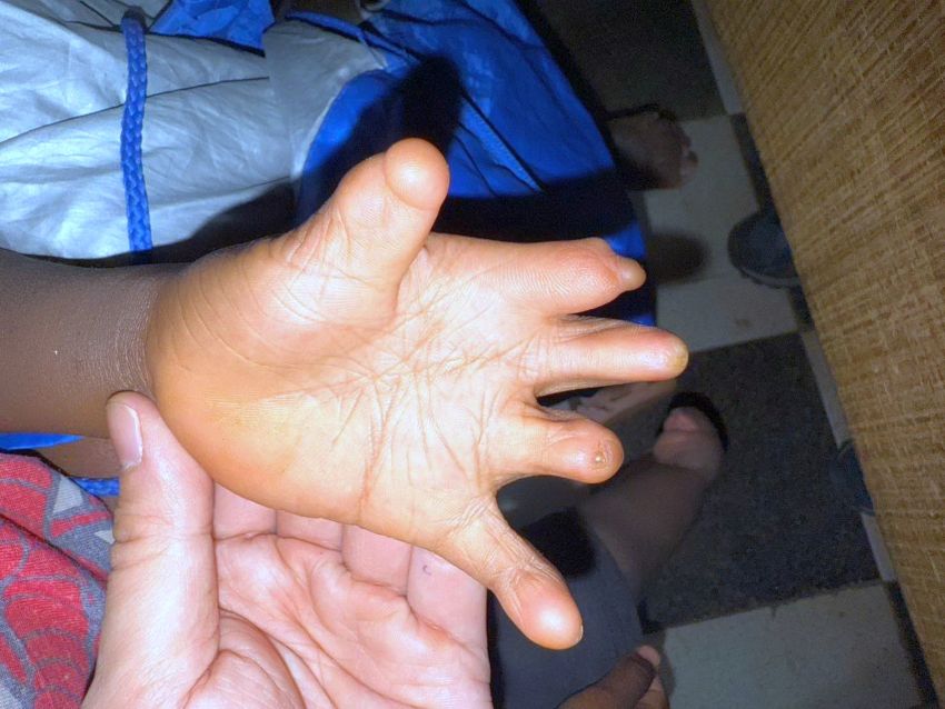 《圖說》台灣路竹會2月前往非洲馬達加斯加義診時，發現5歲病童小扎唇顎裂，四肢不健全（圖），飲食與生活不便。〈台灣路竹會提供提供〉