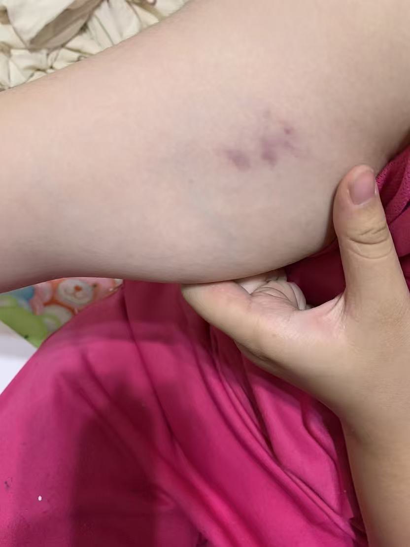 【獨家】【新北校園霸凌爭議】三峽安溪國中女學生遭同學毆傷瘀青!! 家長怒控劣師失職還附和共笑 遭霸凌女學生身體多處部位遭毆瘀青。(圖:投訴者提供)