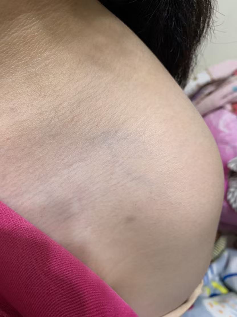 【獨家】【新北校園霸凌爭議】三峽安溪國中女學生遭同學毆傷瘀青!! 家長怒控劣師失職還附和共笑 遭霸凌女學生身體多處部位遭毆瘀青。(圖:投訴者提供)