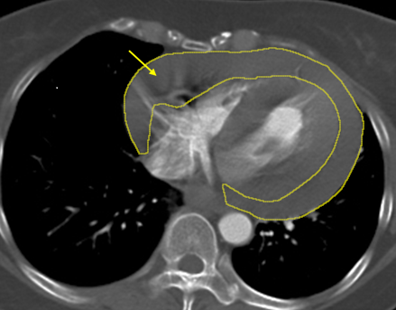 《圖說》鄭元熙醫師指出，經電腦斷層顯示，大量血液積聚於心包膜內（黃圈處），對心臟造成壓迫，若未及時處置恐危及生命。〈土城醫院提供〉
